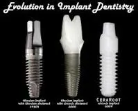 evolution of dental implant procedures